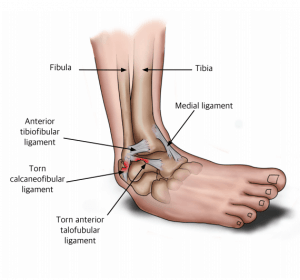 Ankle injury