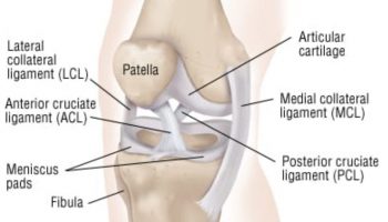 ACL tears in women ACL tears an Osteo perspective