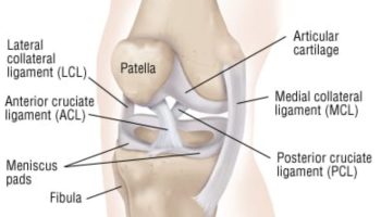 ACL tears an Osteo perspective