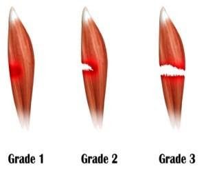 Strain Vs Sprain: What's the Difference? - Alpha Sports Medicine and ...